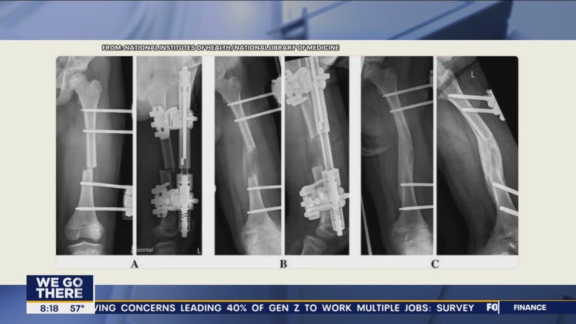 What is limb lengthening surgery?